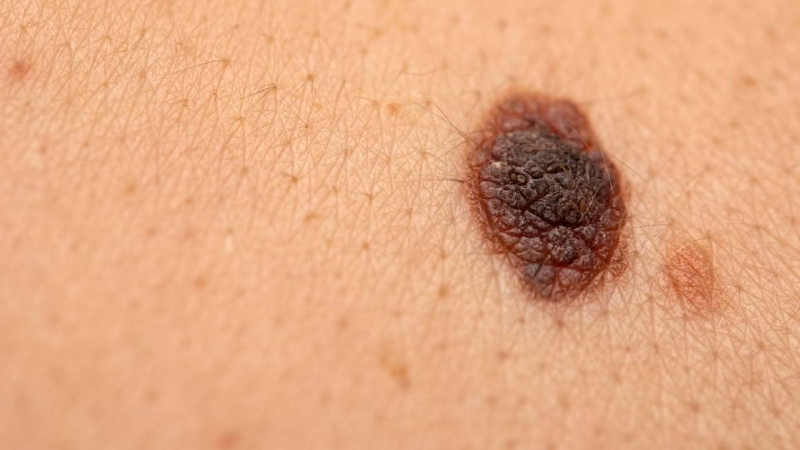 Melanomul malign rezecabil - un nou standard terapeutic?