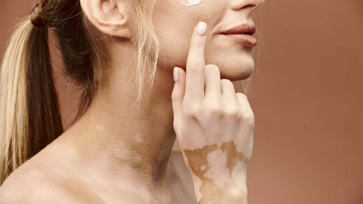 Cu vitiligo la plaja – cum iti protejezi pielea