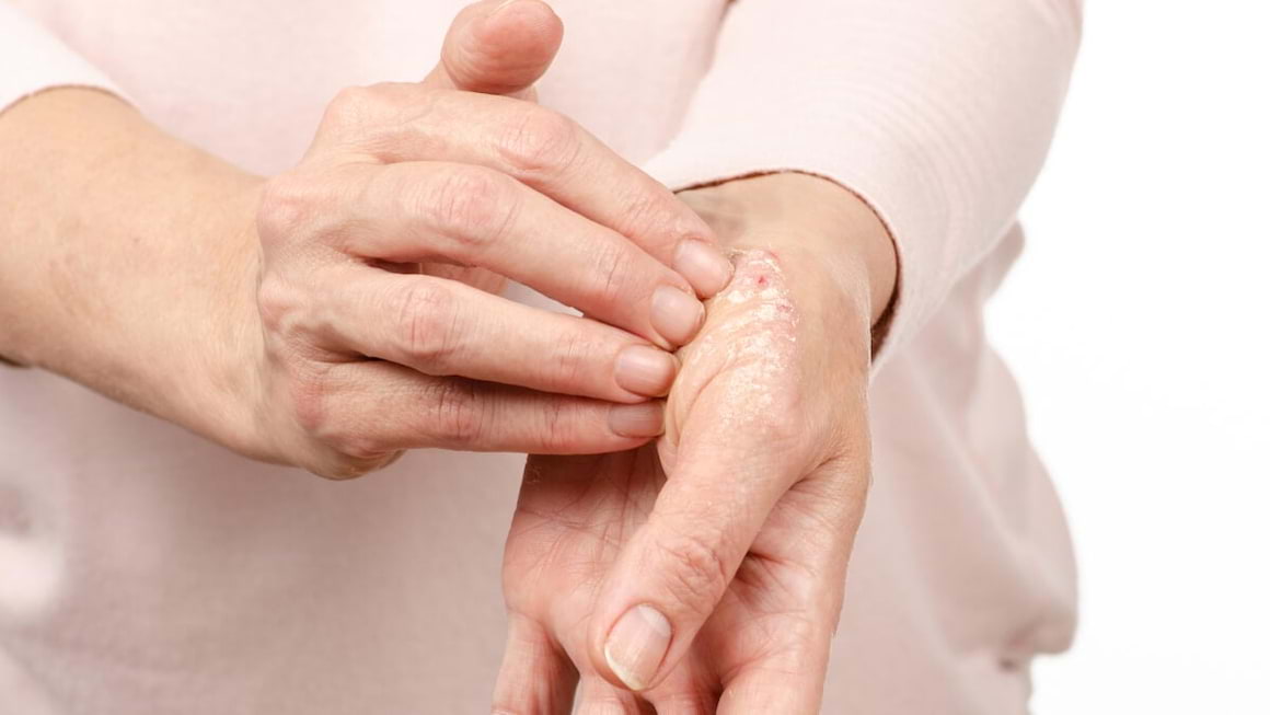 Prin ce se deosebeste artrita psoriazica de artroza: cauze, factori de risc, tratament