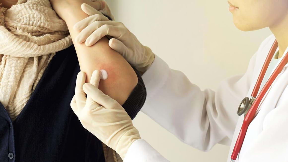 Ai psoriazis? Cum trebuie să-ți îngrijești pielea în sezonul rece