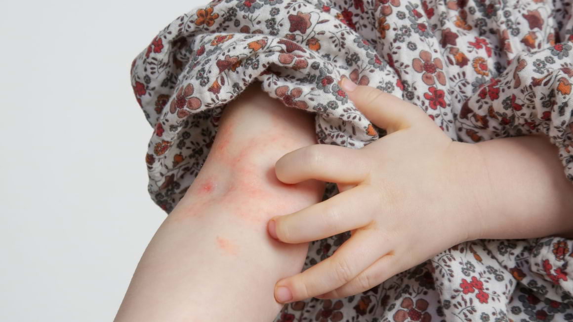 La ce trebuie sa ai grija in vacanta, daca ai un copil cu psoriazis?