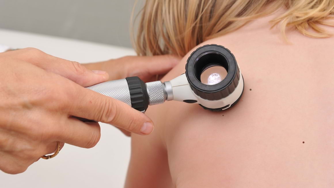 Melanomul la copii si adolescenti: factori de risc