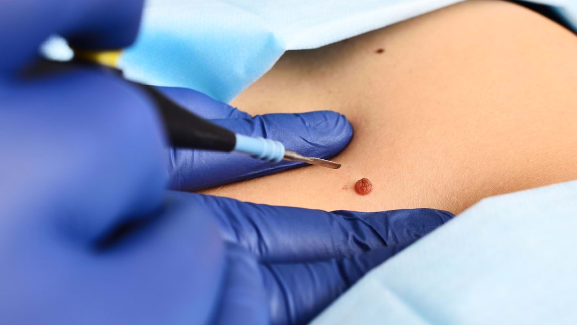 Utilizarea secventierii genomice in managementul melanomului malign