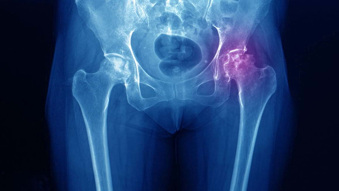 Necroza aseptica de cap femural la pacientii cu lupus