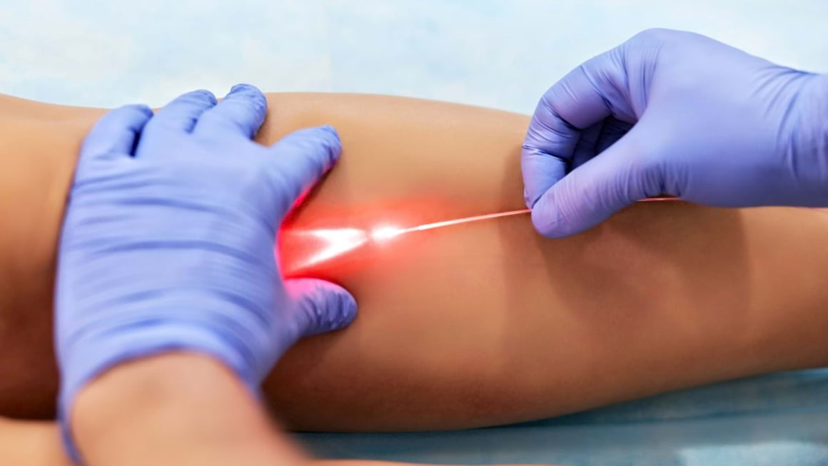Procedurile cu laser in tratarea varicelor - cat de eficiente sunt?