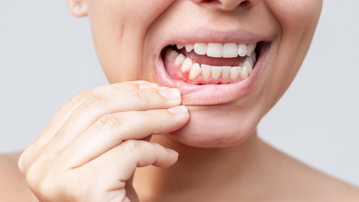 Modificarile gingiei: ce afectiuni poate indica o gingie inflamata?