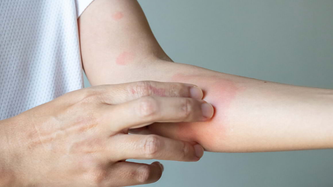 Psoriazisul cauzat de colita ulcerativă - ce trebuie să știi