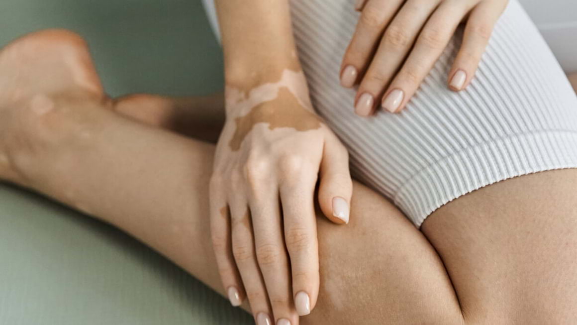 Vitiligo: Cauze, simptome si tratament