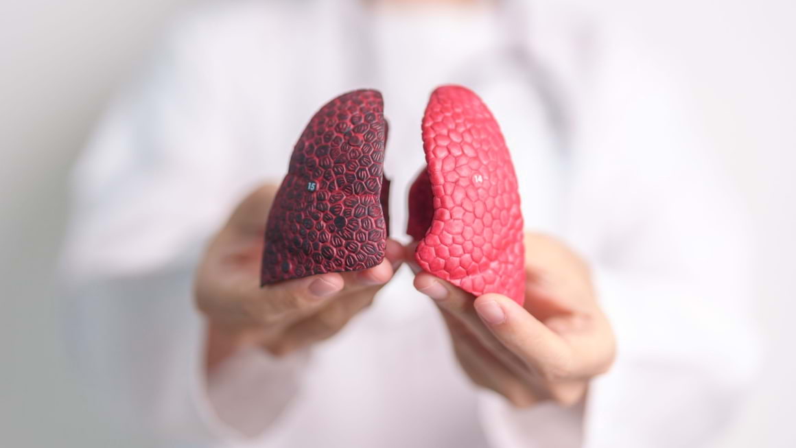 Cum arata cancerul pulmonar