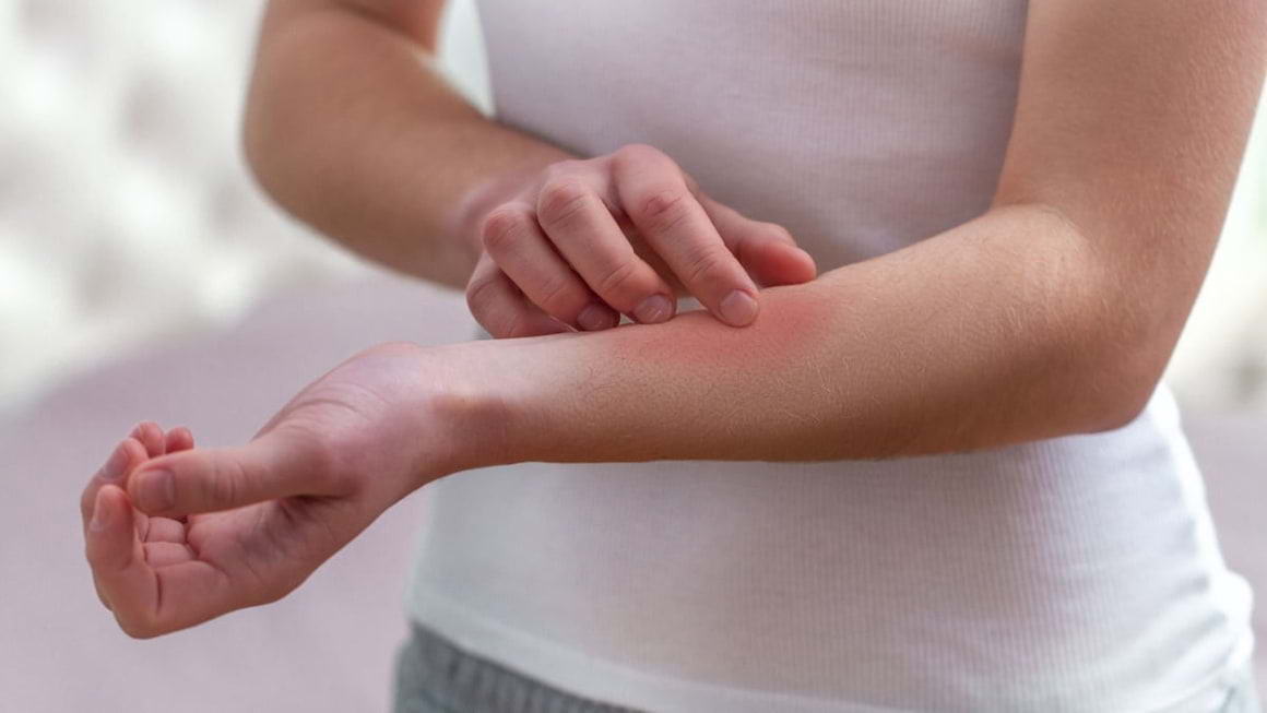 Mușcături de insecte pe care nu trebuie să le ignori