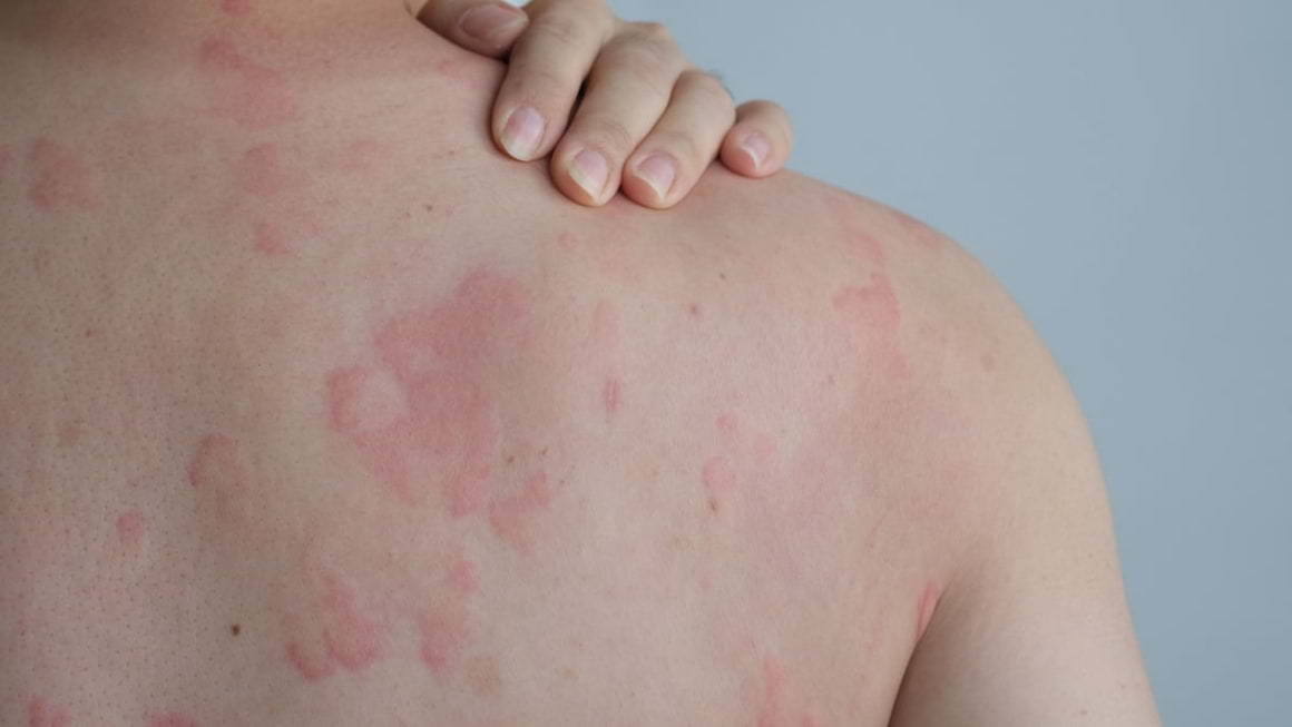 Ce este urticaria cronică idiopatică?