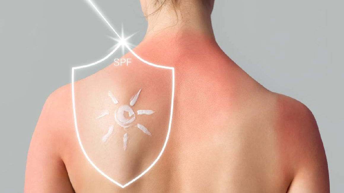 Remedii naturiste pentru arsurile solare