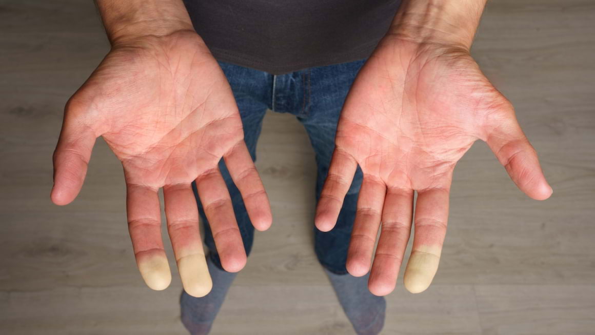 Fenomenul Raynaud, ce este și pe cine poate afecta?