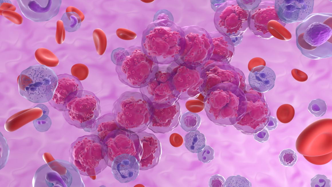Leucemia limfoblastică acută la adulți
