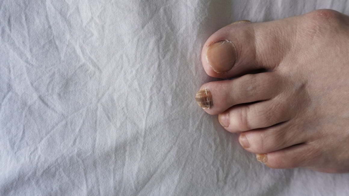 Melanomul lentiginos acral