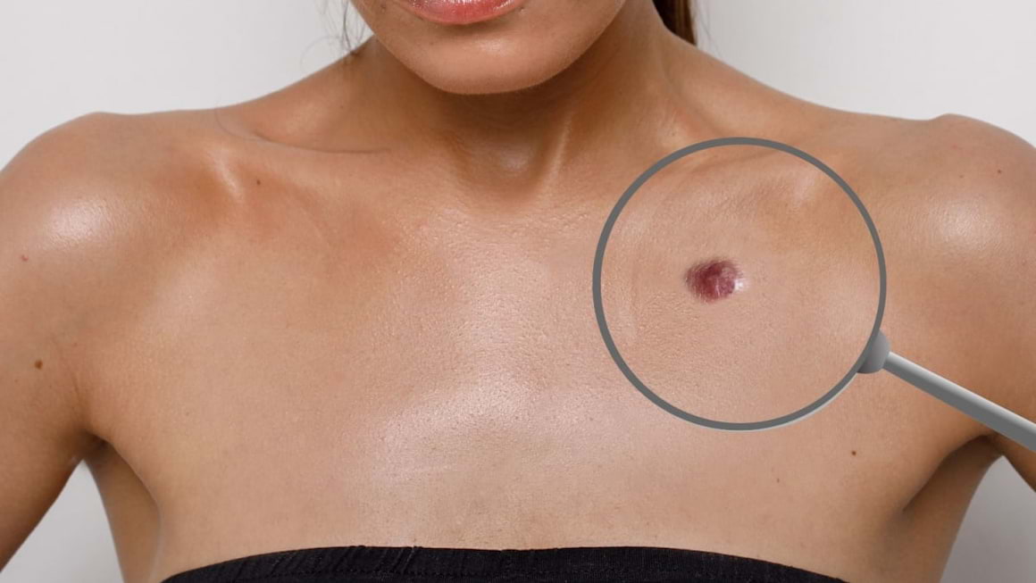 Cancerul de piele nu arata mereu ca o alunita