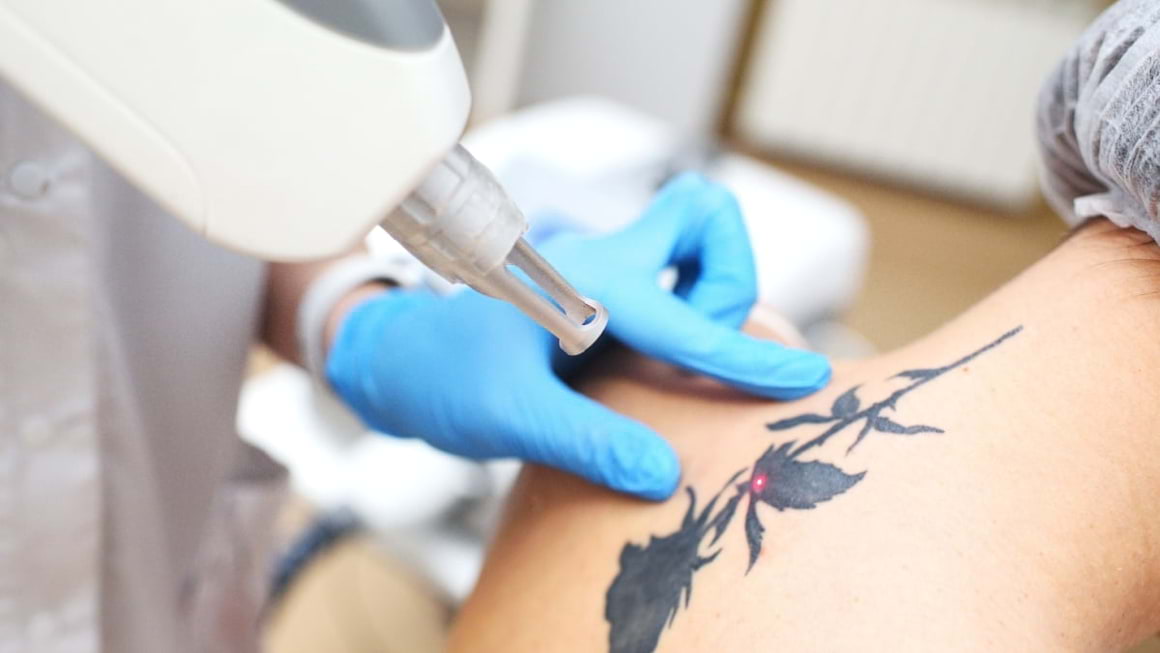 Cum scapi de un tatuaj și la ce riscuri te expui?