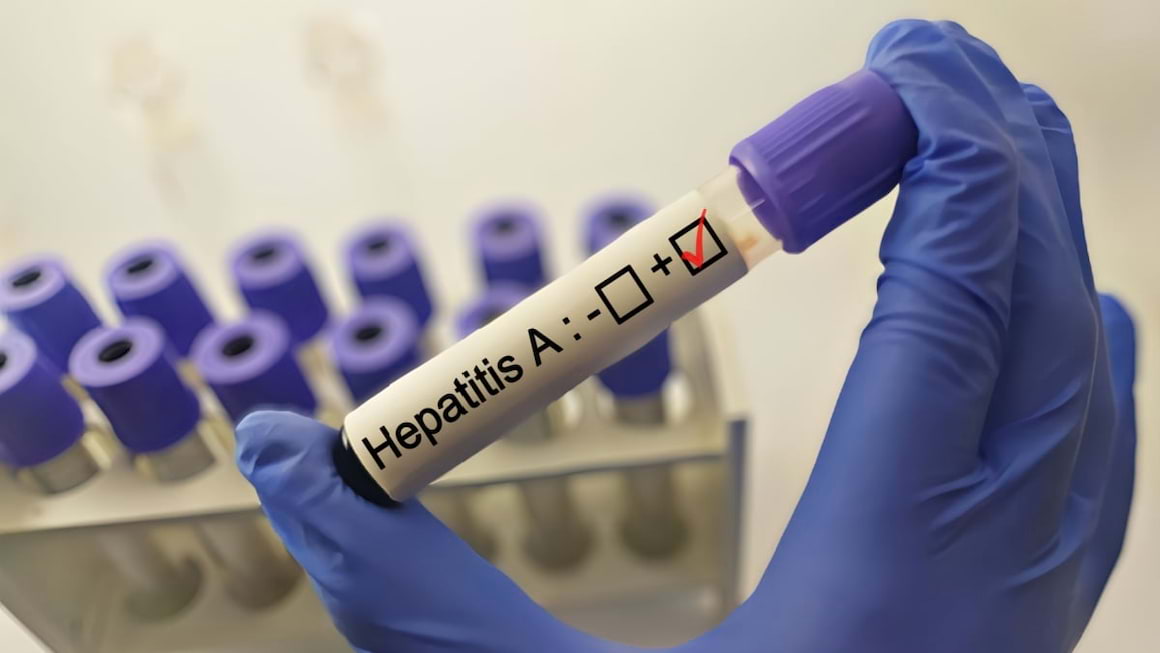 20 de lucruri importante de știut despre hepatita A