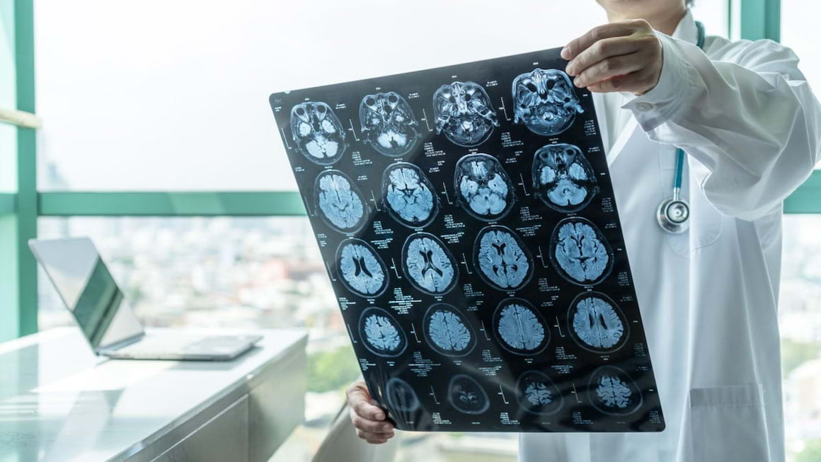 Ce trebuie sa stii despre accidentul vascular cerebral (AVC)?