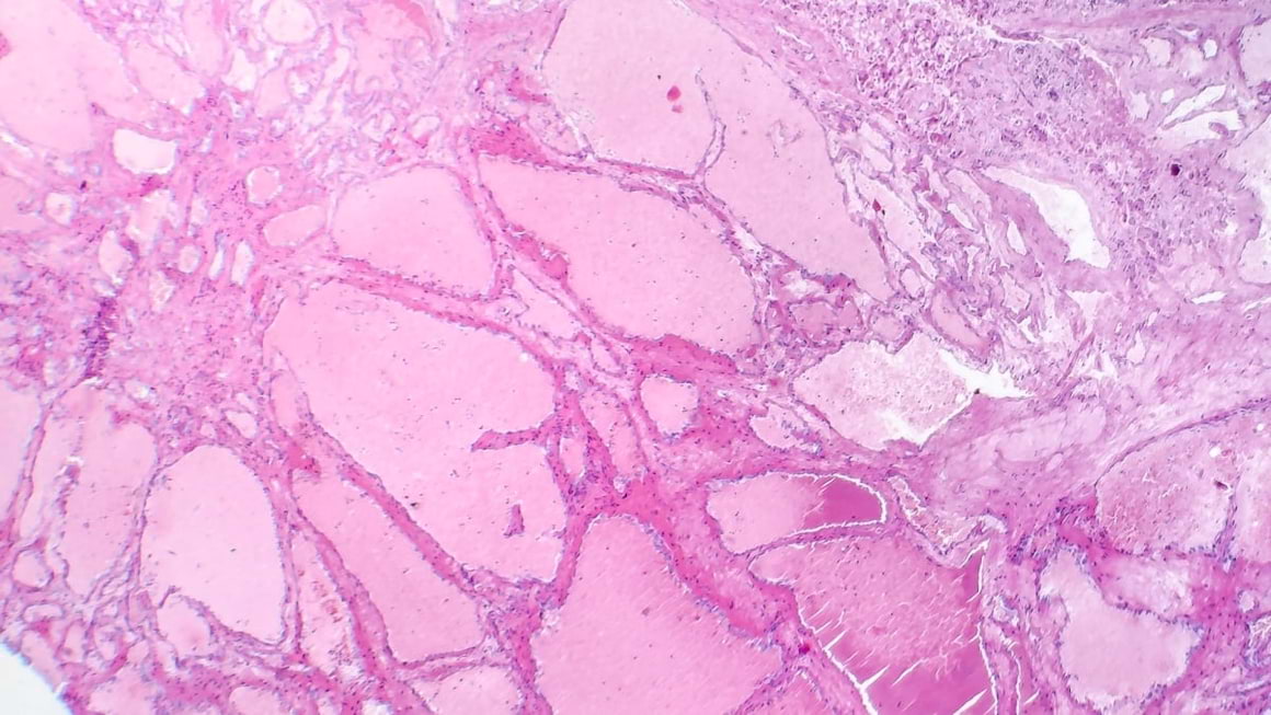 Hemangiomul hepatic: cauze, simptome si tratament