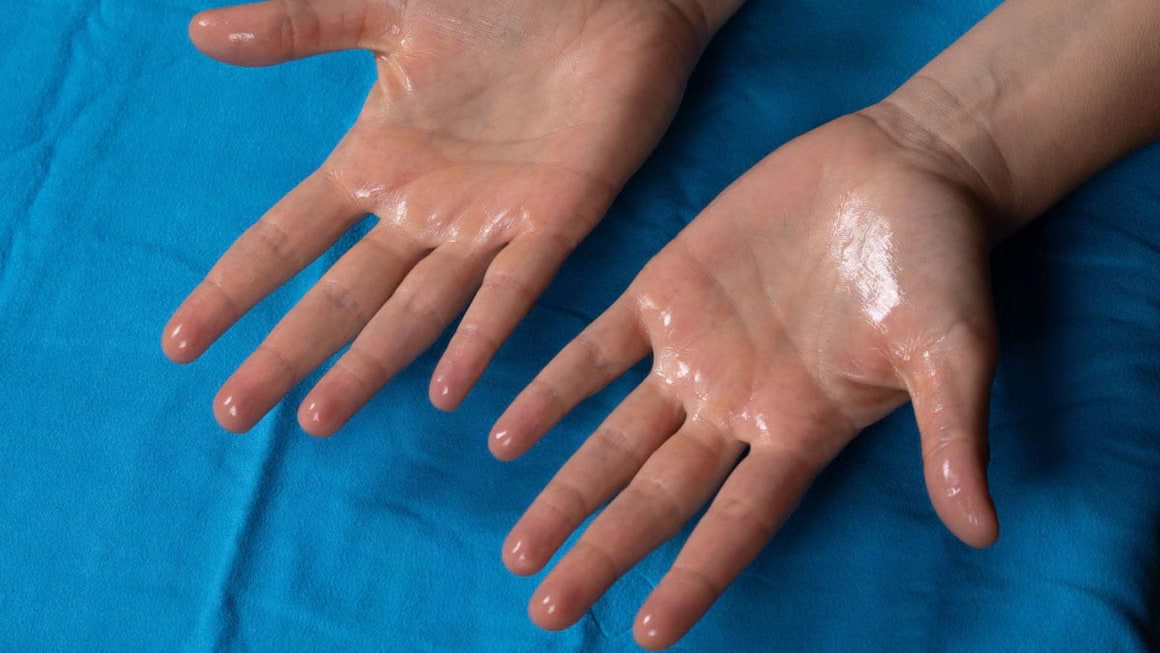 Hiperhidroza palmara si plantara – remedii pentru transpiratia excesiva
