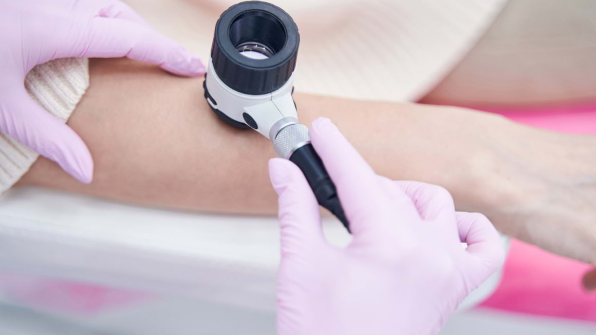Dermatoscopia in evaluarea nevilor