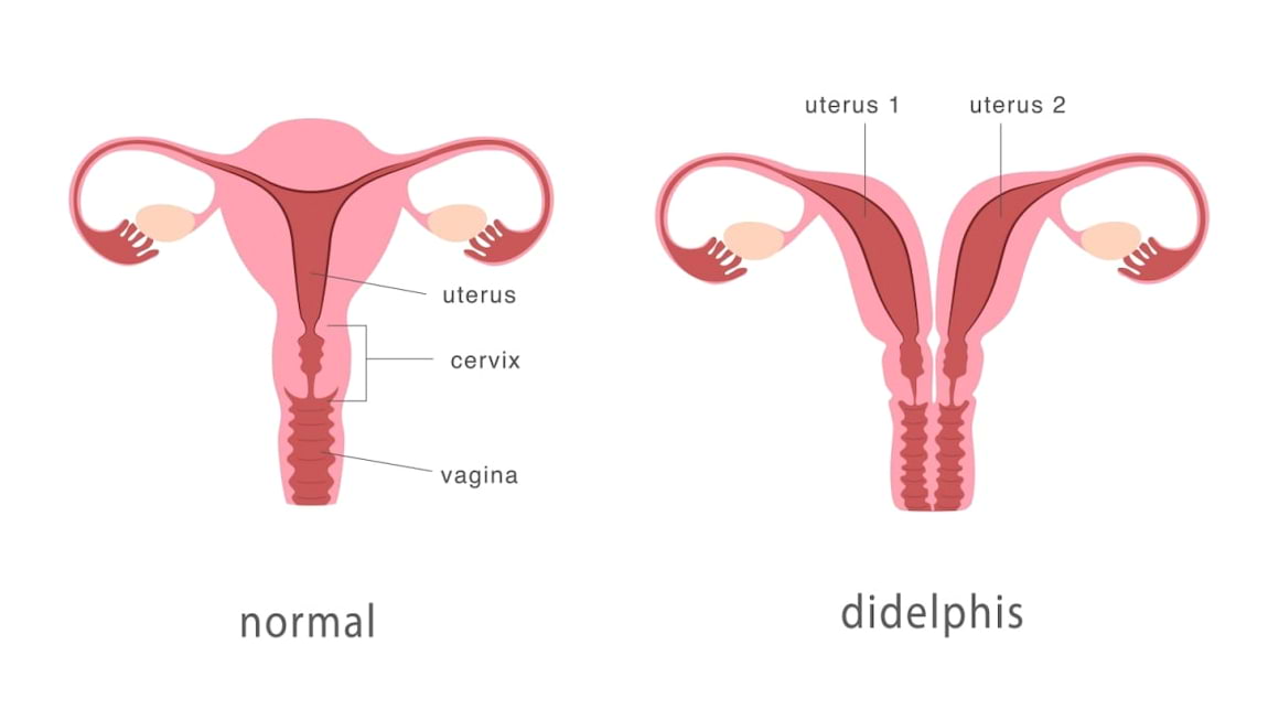 Ce este uterul didelf (uter dublu) și cum se tratează