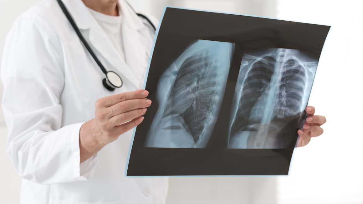 Complicatii ale cancerului la plamani
