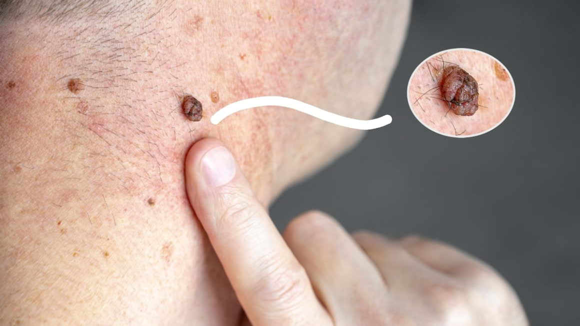 Factori de prognostic in melanom