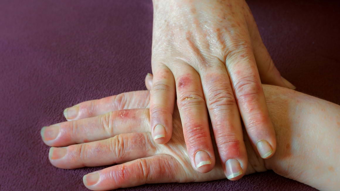 Recomandări pentru pacienții cu fenomen Raynaud