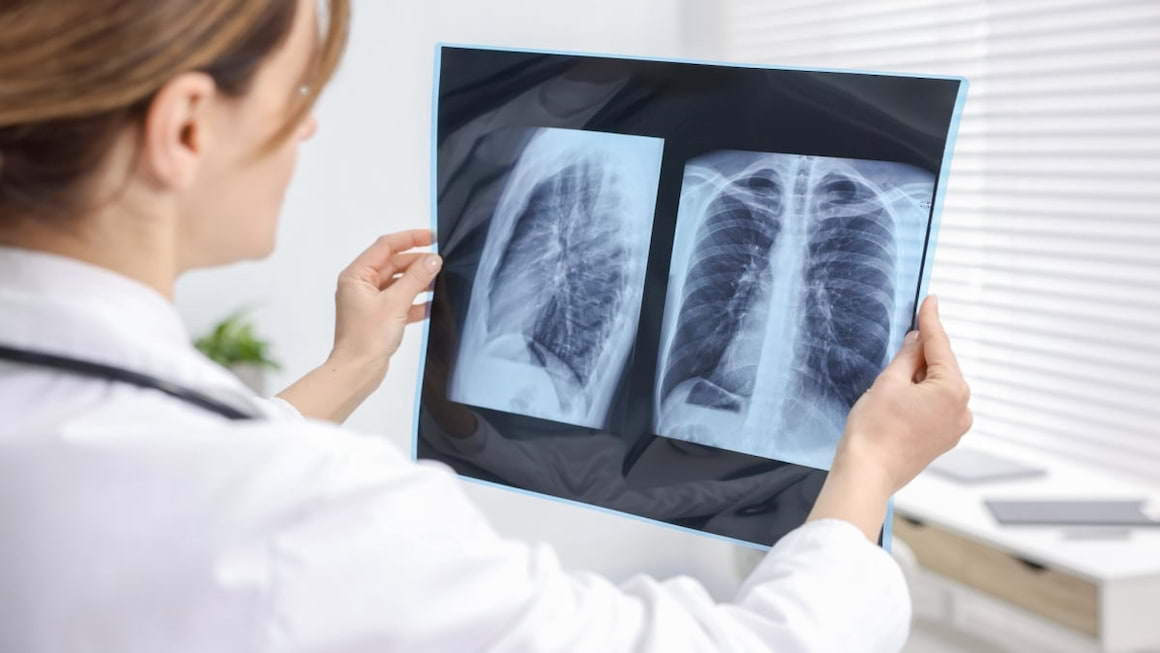 Terapia de primă linie în cancer pulmonar