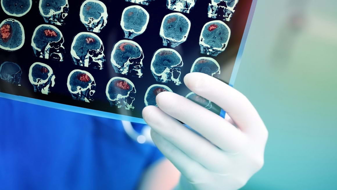 Diferențe între un accident vascular cerebral ischemic și unul hemoragic