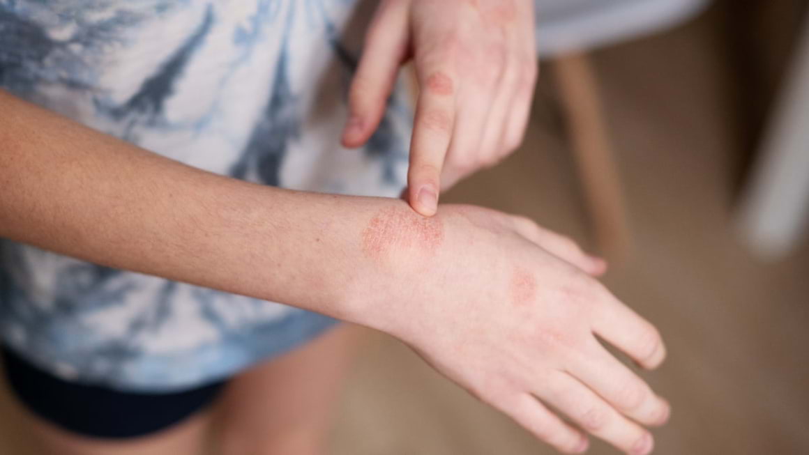Cele mai frecvente tipuri de dermatită