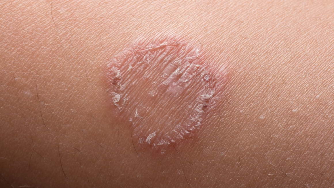 Pecingine: cauze, simptome, diagnostic și tratament