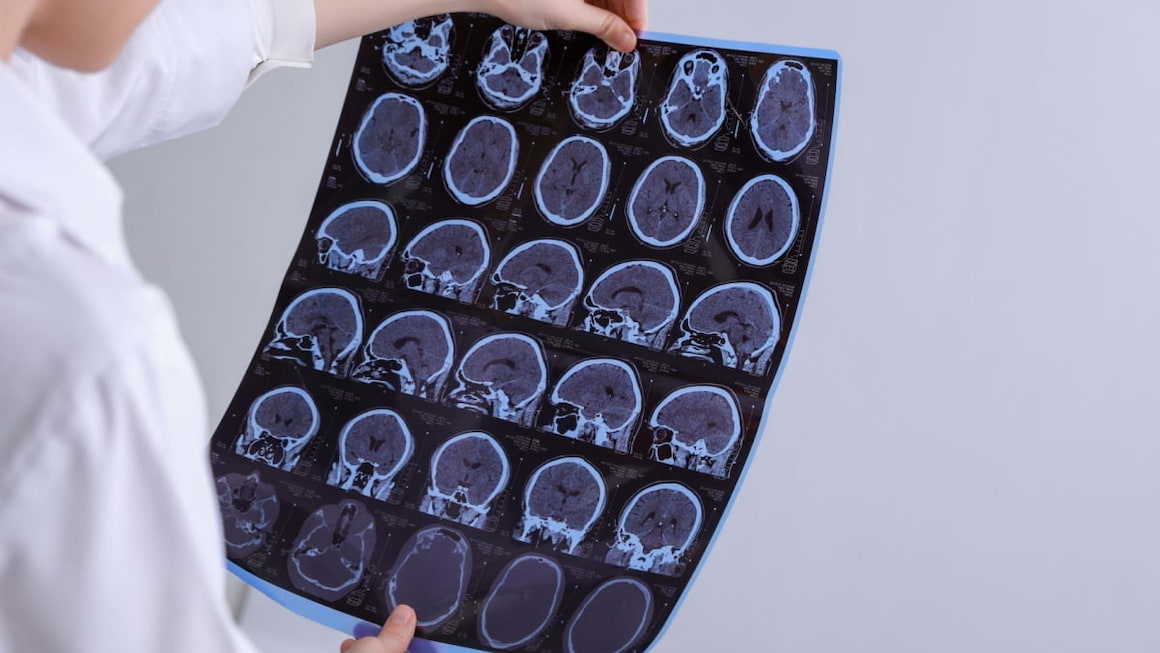 Leziuni demielinizante: cauze, simptome diagnostic
