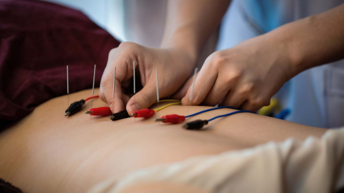 Electroacupunctura: ce este și când se recomandă?