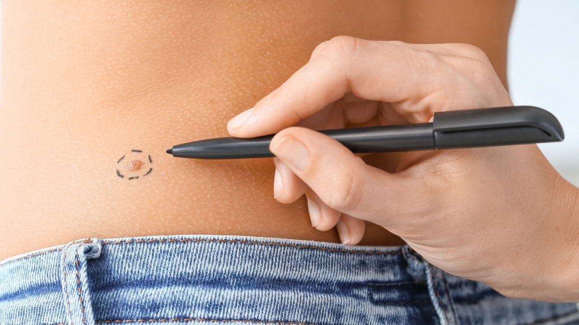 Instruirea cuplurilor face mai usoara depistarea cancerului de piele