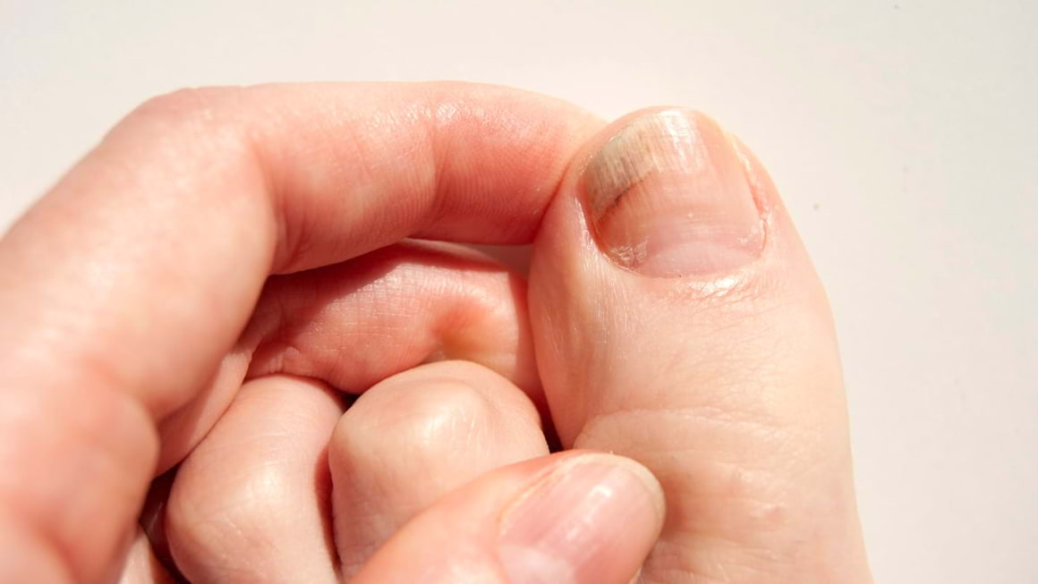Micoza unghiei: diagnosticare, tratament si prevenire