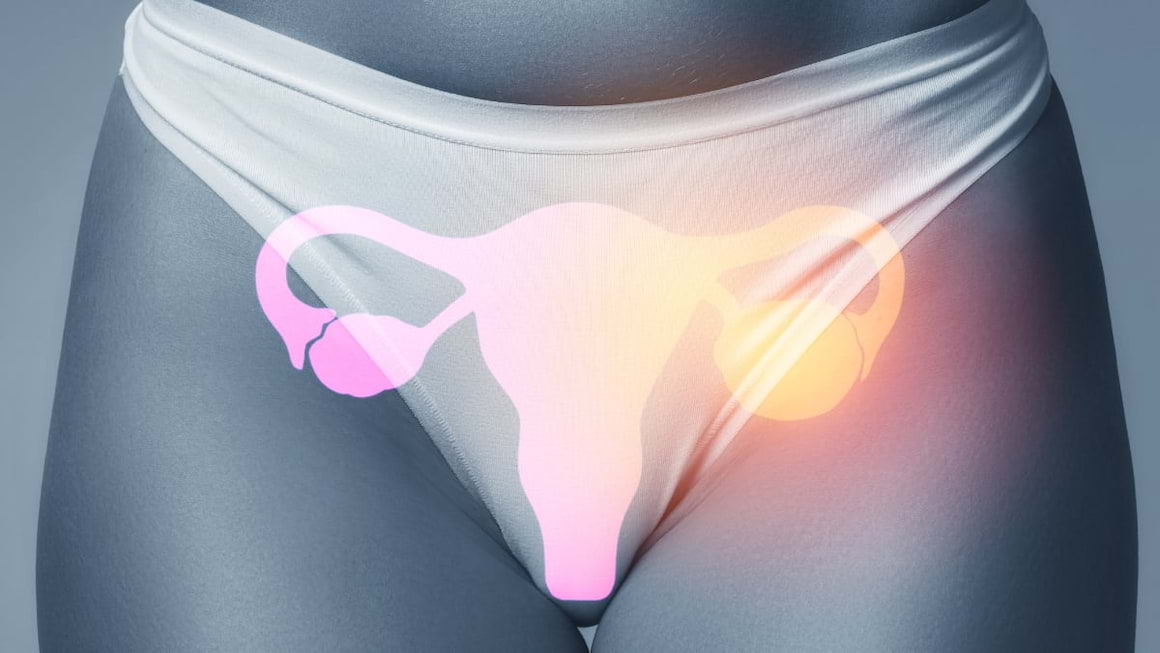 Ovare marite: cauze, simptome si tratament