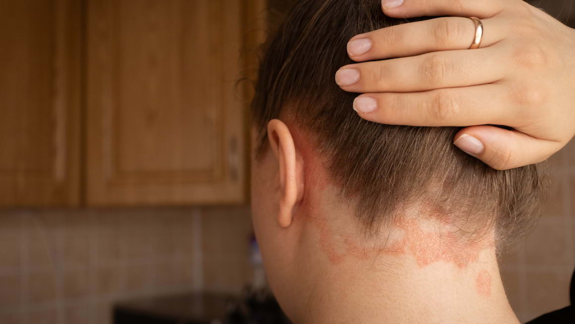 Psoriazis: cauze, simptome si tratament
