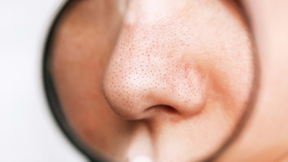 Punctele negre: cum le elimini natural?