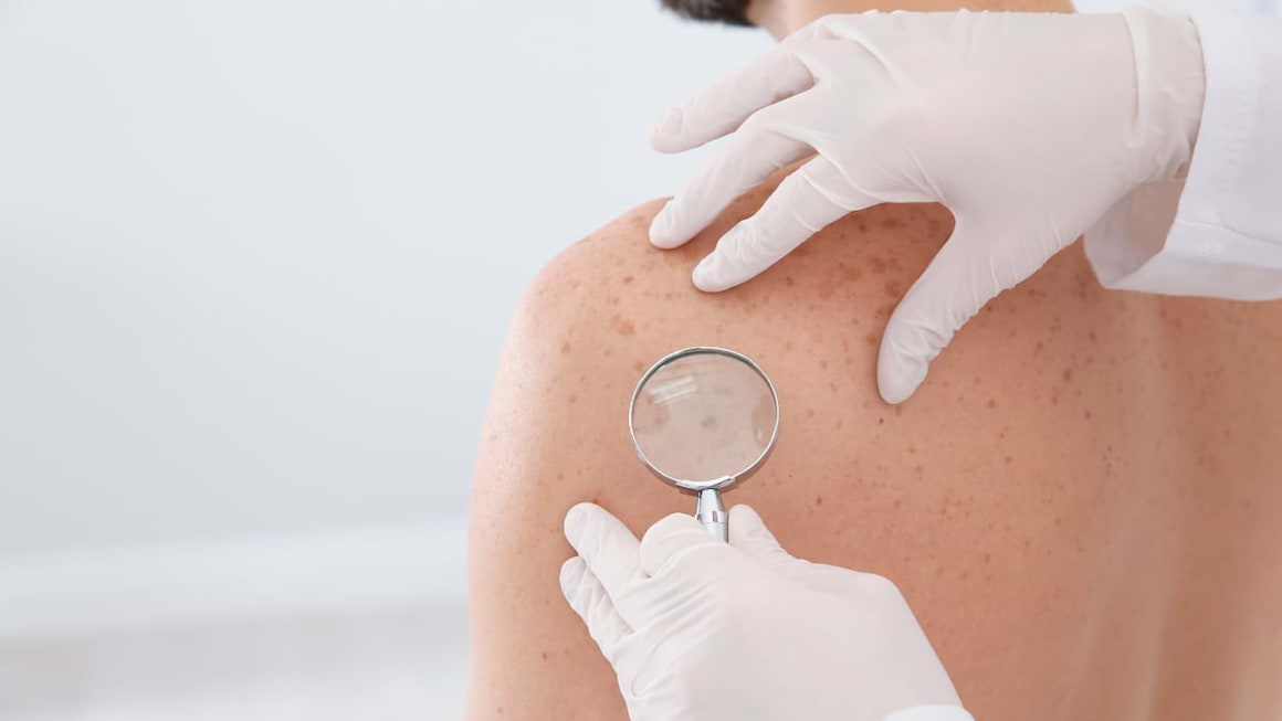 8 simptome ale cancerului de piele pe care le ignori