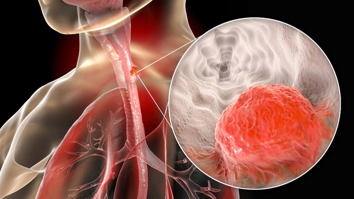 Cancerul esofagian, locul sase in lume in topul mortalitatii prin cancer