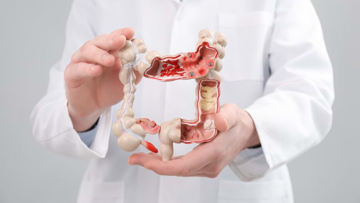 Știi ce simptome are un infarct intestinal?