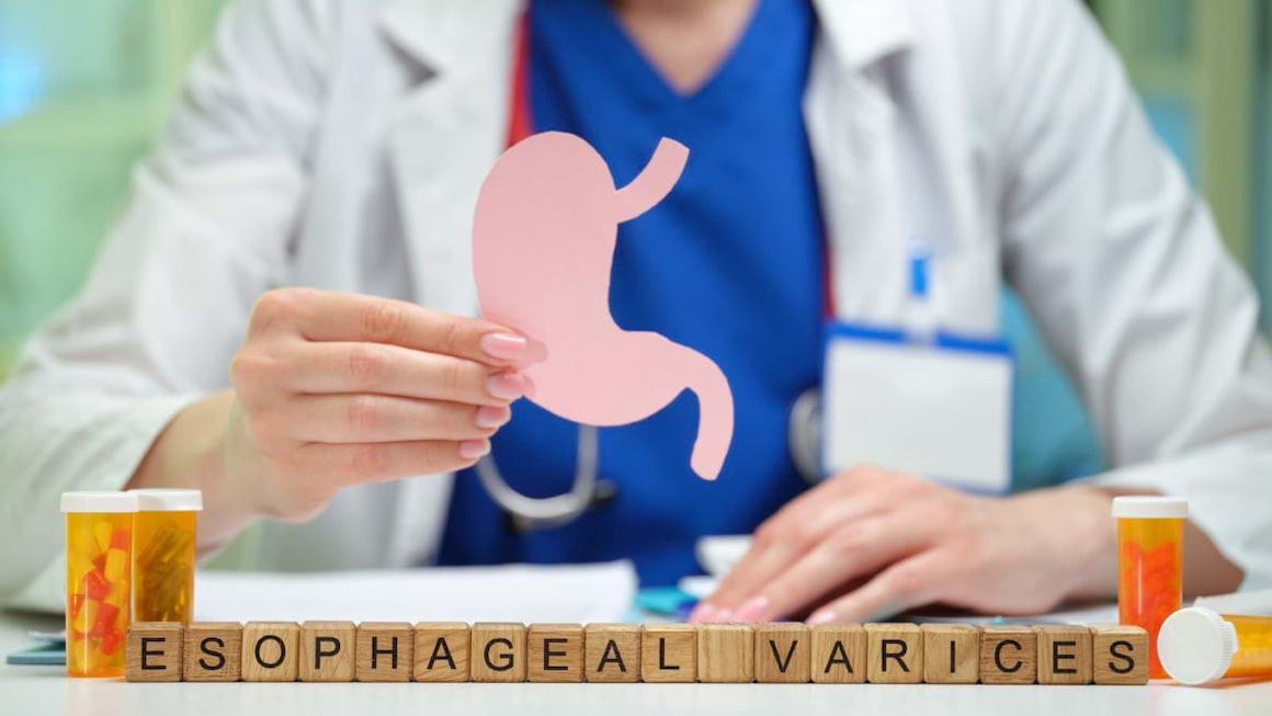 Varicele esofagiene, frecvente la pacientii cu probleme hepatice
