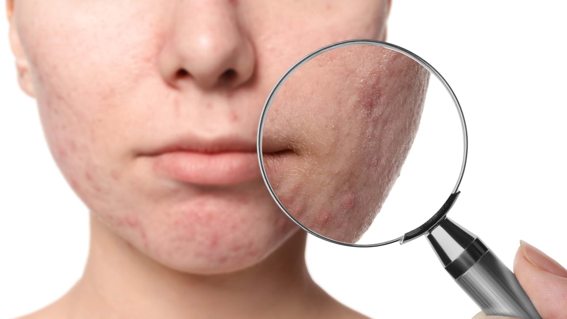 5 obiceiuri care contribuie la cicatricile aparute dupa acnee