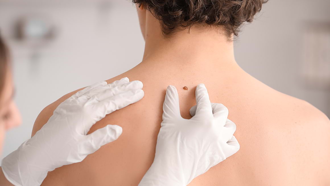 Bărbații, mai expuși melanomului decât femeile
