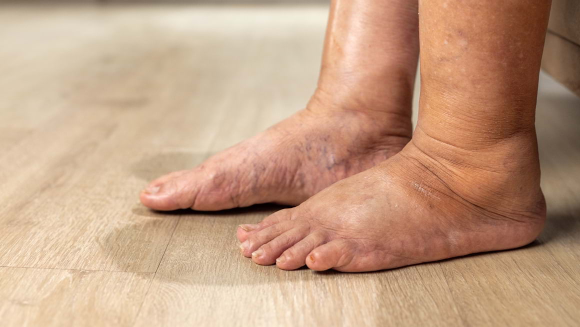Picior diabetic: cauze, simptome, tratament