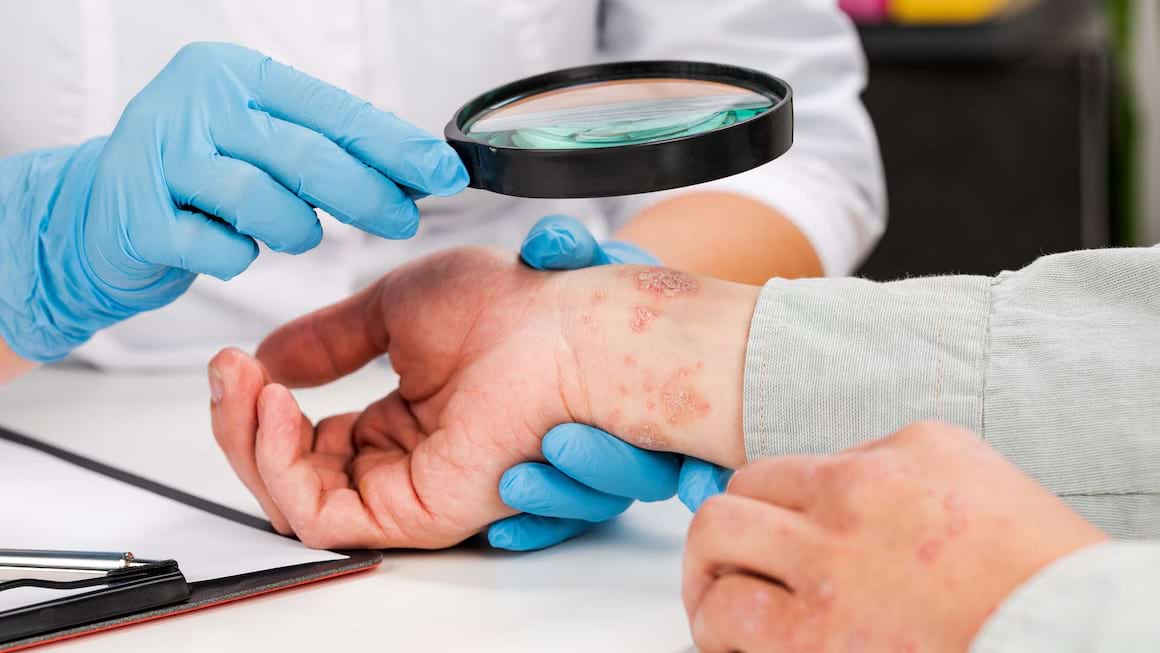 Tratamentul psoriazisului ar putea fi optimizat, arata studiile pe animale