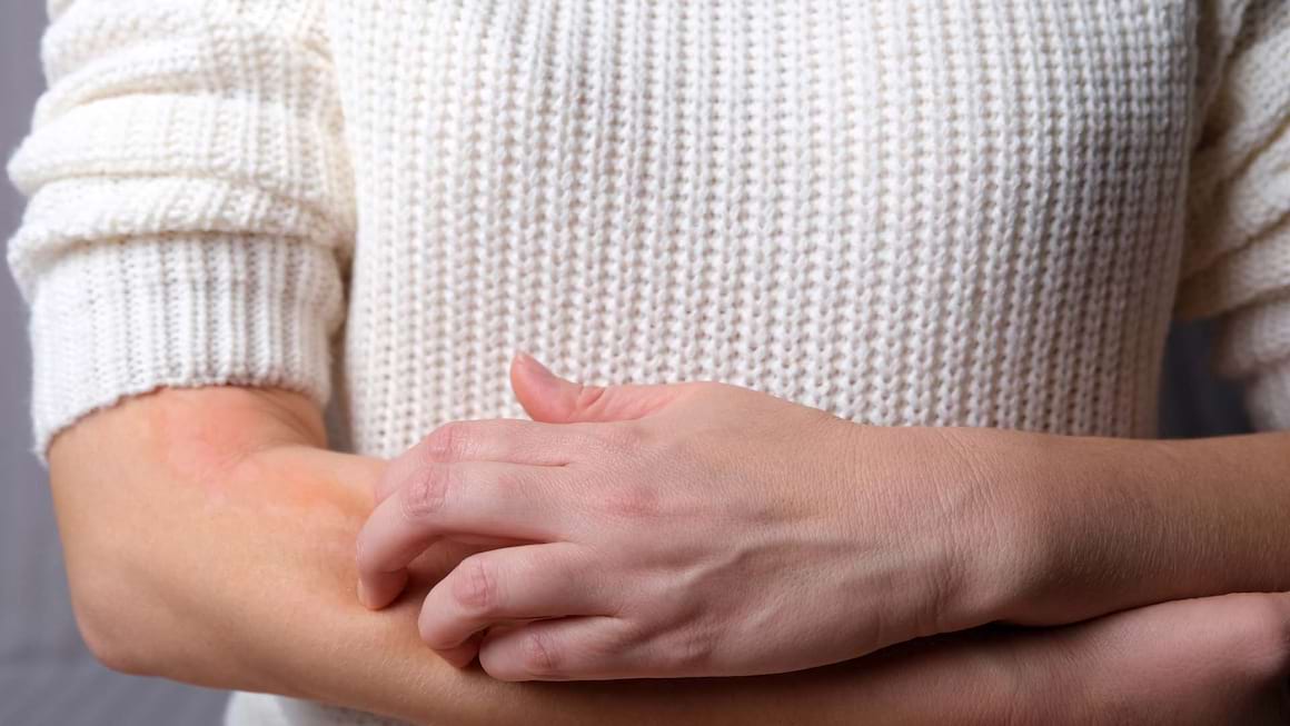 Urticaria: cauze, simptome si tratament
